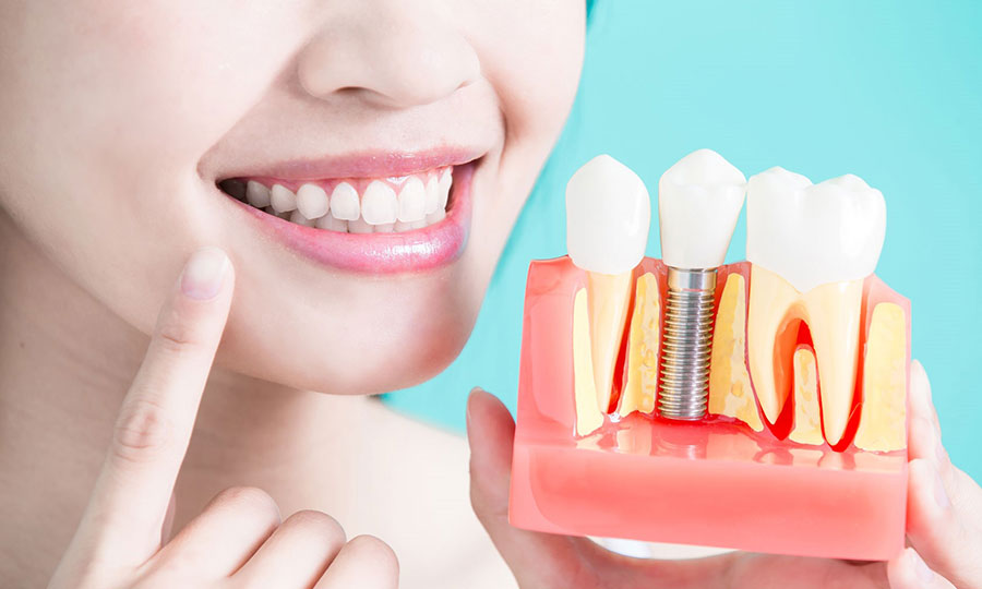 Implantes Dentales Clínica Dental Ribes Altea