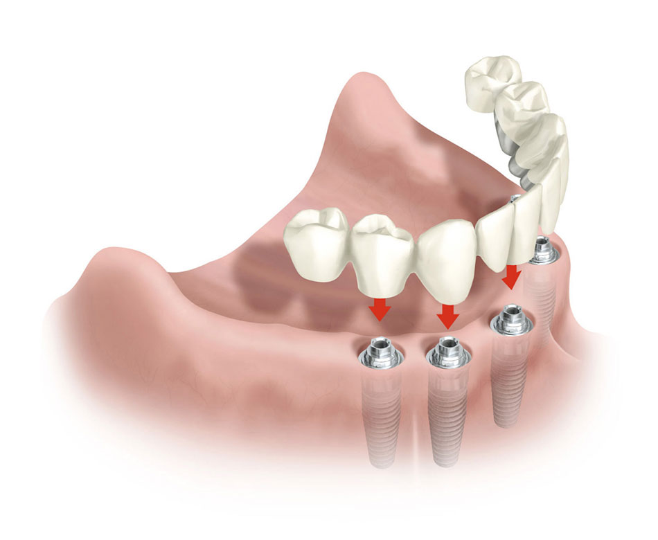 Implantes Prótesis Dentales Clínica Dental Ribes Altea