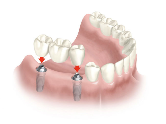 Prótesis Fija Implantes Clínica Dental Ribes Altea
