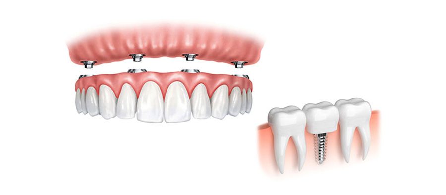 Prótesis Carga Inmediata Clínica Dental Ribes Altea