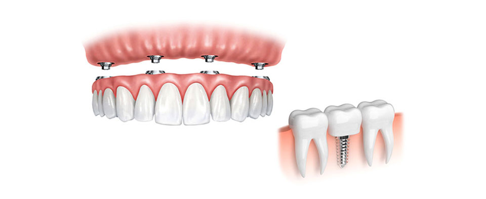 Prótesis Carga Inmediata Clínica Dental Ribes Altea